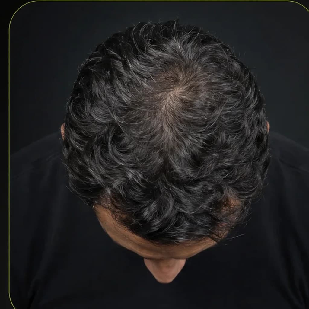 Top-of-crown guided scan angle